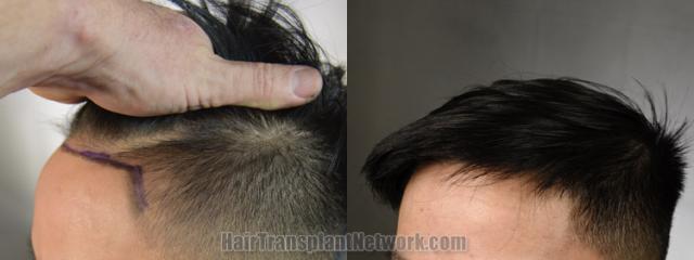 Before and after hair transplantation result photographs