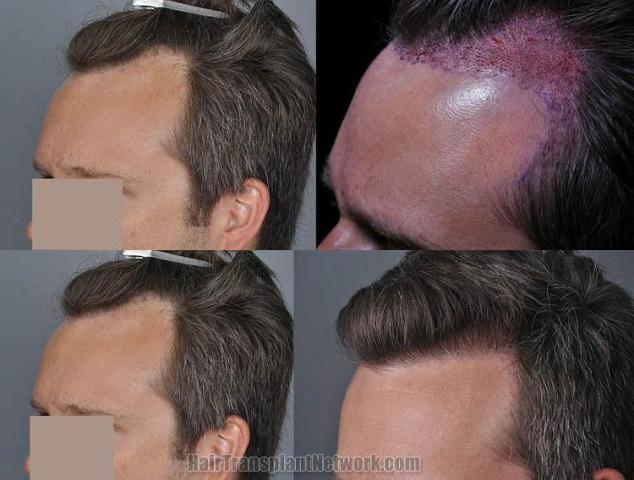 Hair transplantation surgery before and after photos