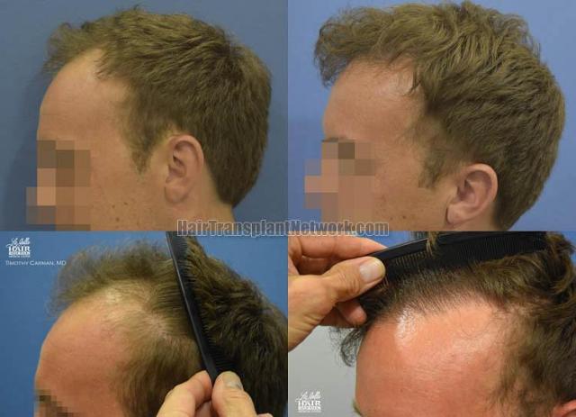 Hair transplantation surgery before and after pictures