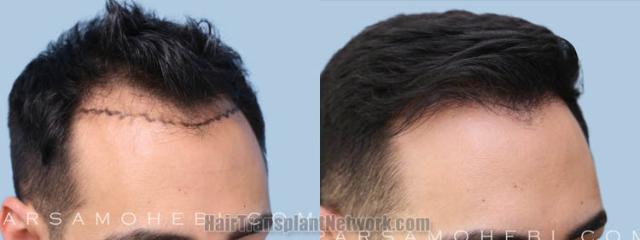 Before and after hair transplantation result photographs