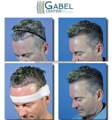 Hair transplantation surgery before and after photos