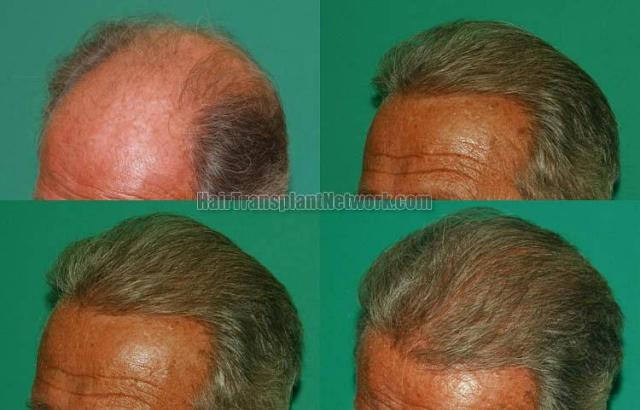 Hair restoration procedure before and after pictures