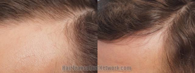 Before and after hair transplantation result photographs