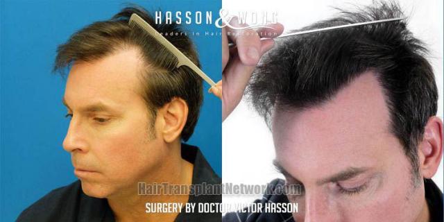 Surgical hair transplantation result photographs