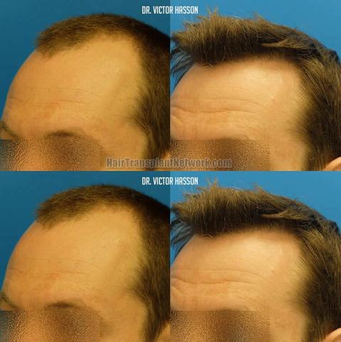 Hair restoration surgery before and after images