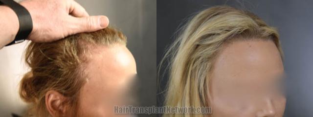 Before and after hair transplantation result photographs