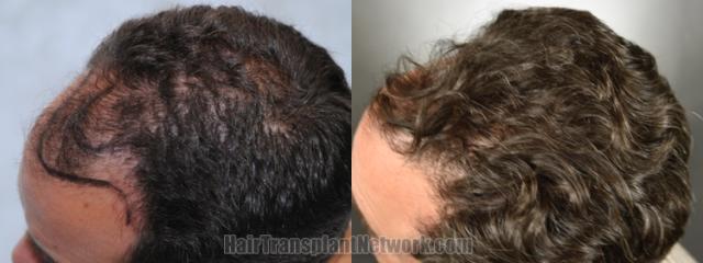 Before and after hair transplantation result photographs