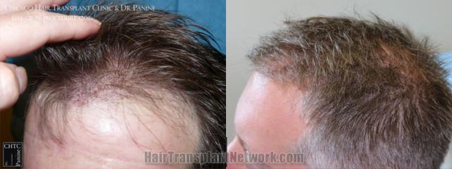 Before and after hair transplantation result photographs