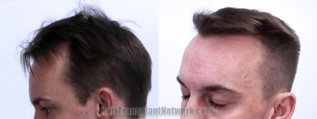 Before and after hair transplantation result photographs