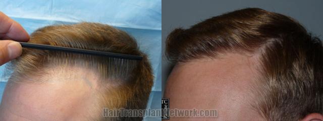 Before and after hair transplantation result photographs