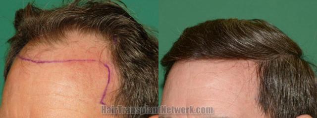 Before and after hair transplantation result photographs