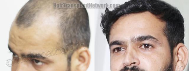 Before and after hair transplantation result photographs