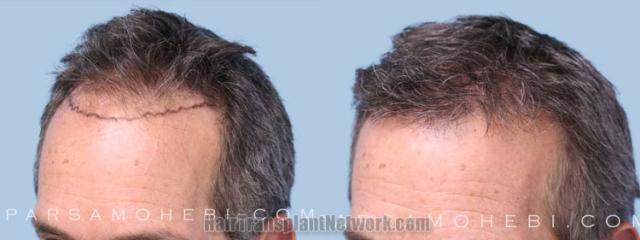 Before and after hair transplantation result photographs