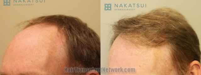 Before and after hair transplantation result photographs