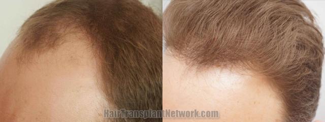 Before and after hair transplantation result photographs