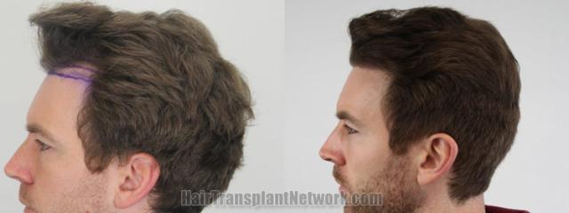 Before and after hair transplantation result photographs