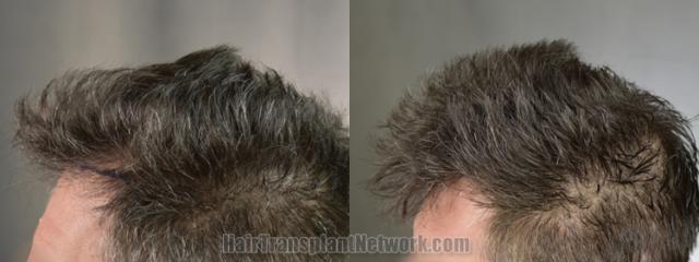 Before and after hair transplantation result photographs