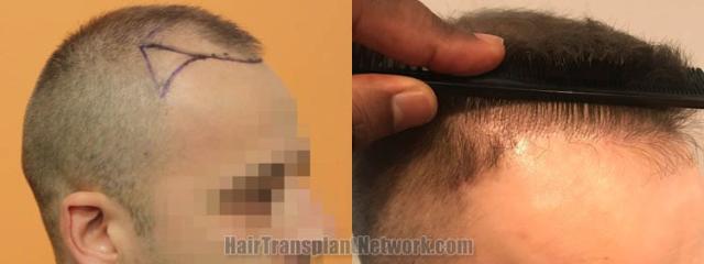 Hair restoration procedure before and after pictures