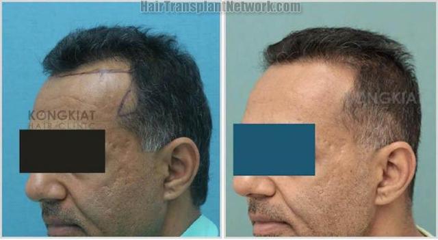 Hair transplantation surgery before and after photos