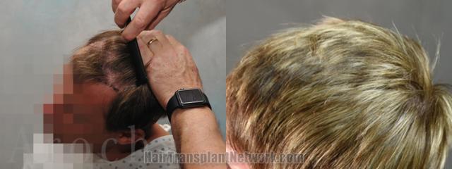 Before and after hair transplantation result photographs