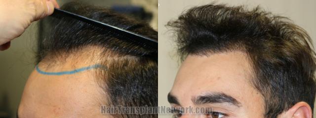 Before and after hair transplantation result photographs