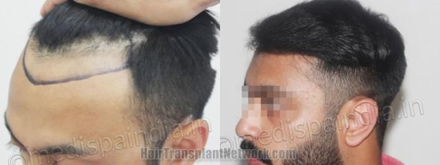 Before and after hair transplantation result photographs