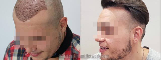 Before and after hair transplantation result photographs