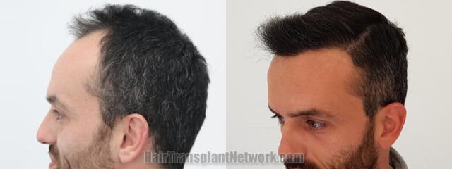 Before and after hair transplantation result photographs