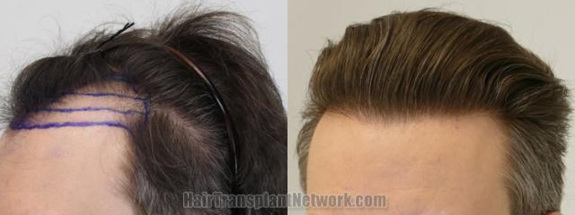 Before and after hair transplantation result photographs