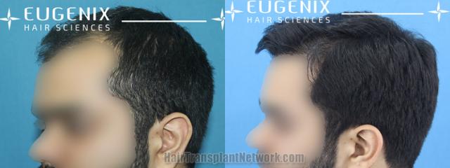 Before and after hair transplantation result photographs