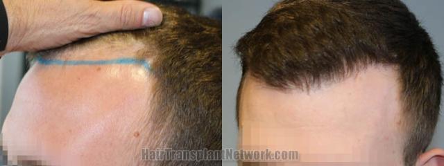 Before and after hair transplantation result photographs