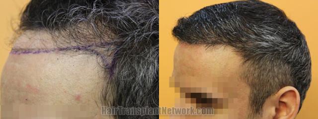 Before and after hair transplantation result photographs