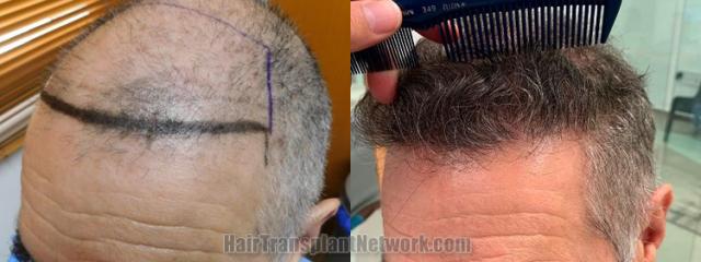 Before and after hair transplantation result photographs