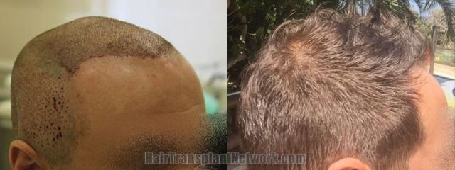 Before and after hair transplantation result photographs