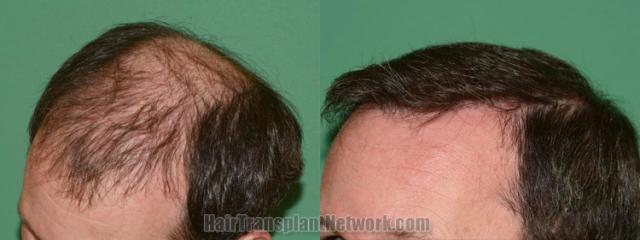 Before and after hair transplantation result photographs