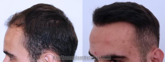 Before and after hair transplantation result photographs