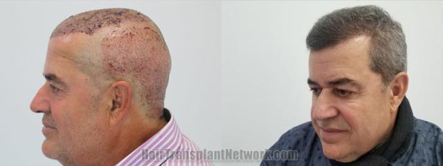 Hair restoration procedure results