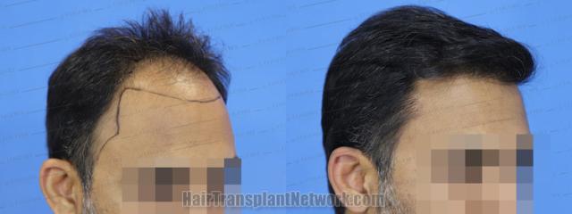  before and after result photographs