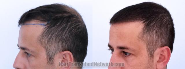 Before and after hair transplantation result photographs