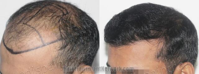 Before and after hair transplantation result photographs