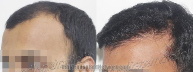 Before and after hair transplantation result photographs