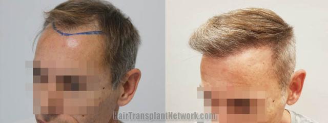 Before and after hair transplantation result photographs