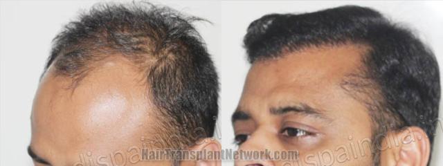 Hair restoration procedure before and after pictures