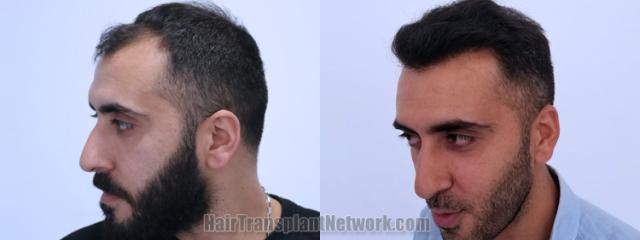 Before and after hair transplantation result photographs