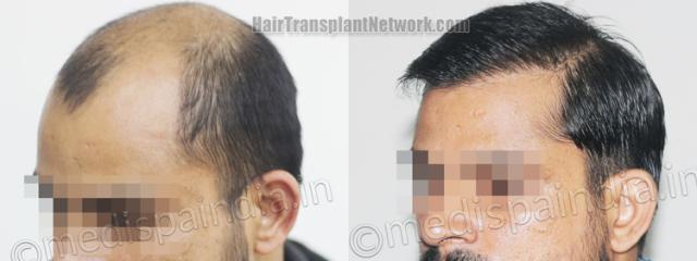 Before and after hair transplantation result photographs