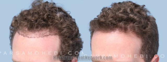 Before and after hair transplantation result photographs