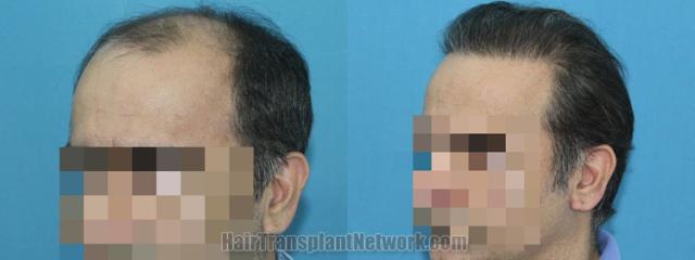 Before and after hair transplantation result photographs