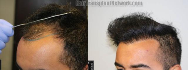 Before and after hair transplantation result photographs