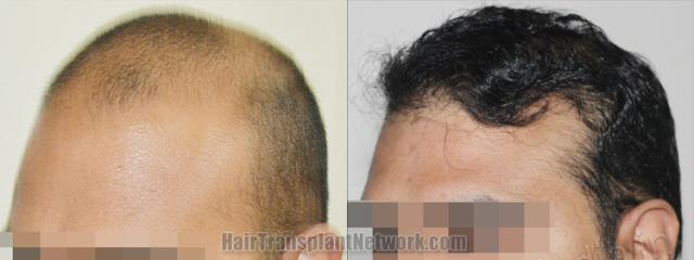 Before and after hair transplantation result photographs