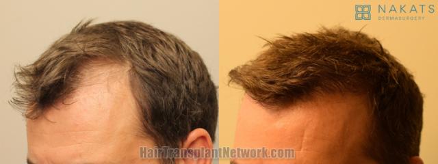 Before and after hair transplantation result photographs